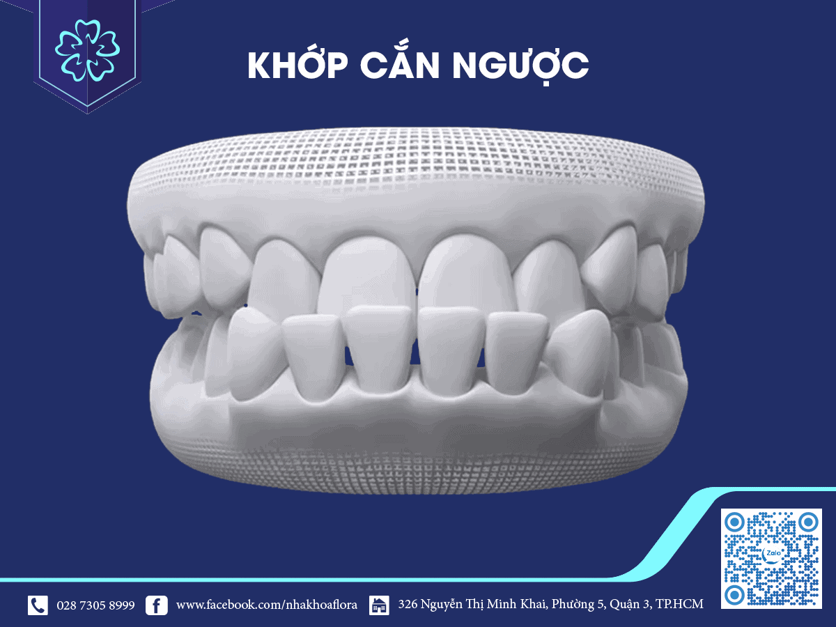khớp cắn ngược