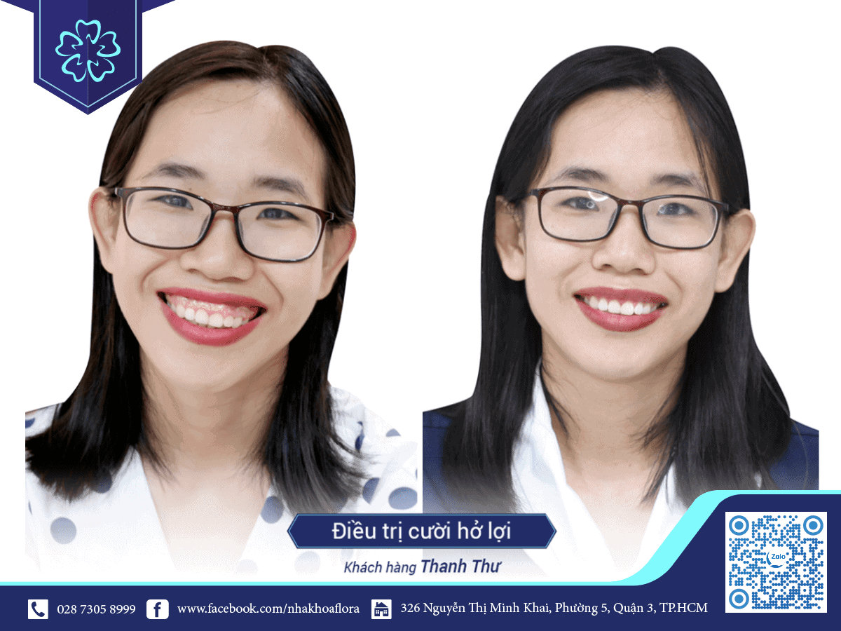 Khách hàng phẫu thuật cười hở lợi thành công