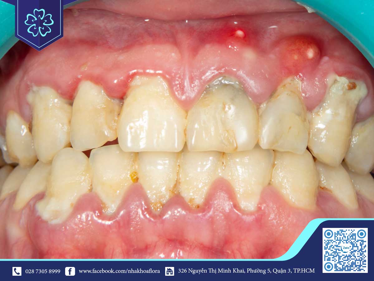 WHAT ARE THE MANIFESTATIONS OF THE EARLY STAGES AFTER PORCELAIN TEETH? FLORA DENTISTRY ADVISES YOU 2