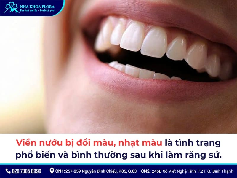 biểu hiện sau khi bọc răng sứ