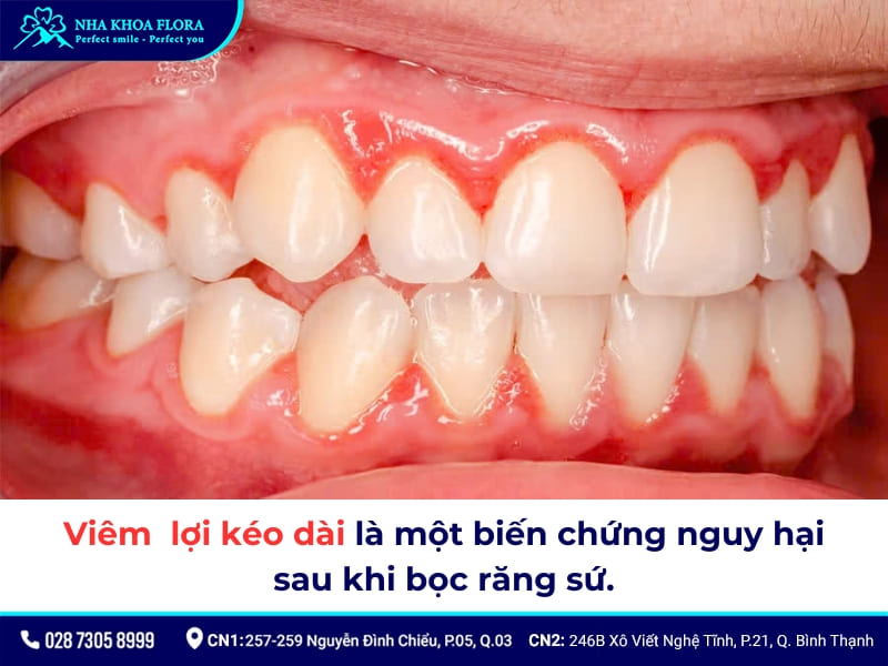biểu hiện sau khi bọc răng sứ
