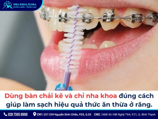 cách chăm sóc răng miệng khi niềng răng - ảnh 3