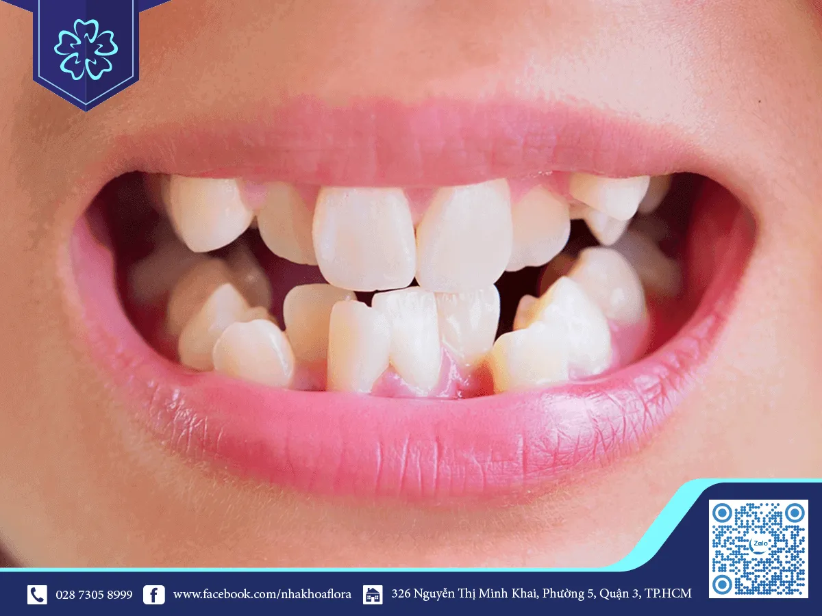 The teeth should be braced.