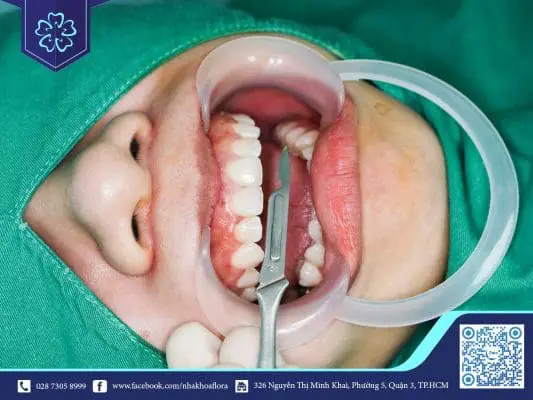 CÁCH CHĂM SÓC SAU KHI CẮT NƯỚU RĂNG HIỆU QUẢ HỒI PHỤC NHANH CHÓNG 2