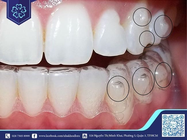 niềng răng trong suốt invisalign