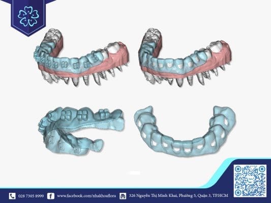 DID YOU KNOW ABOUT 3D CLEAR ALIGNER BRACES? 2