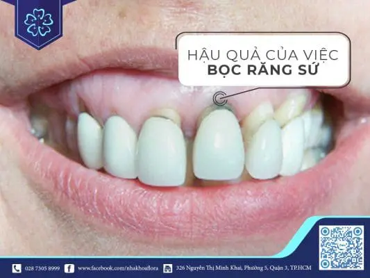 TÌM HIỂU VỀ HẬU QUẢ CỦA VIỆC BỌC RĂNG SỨ 1