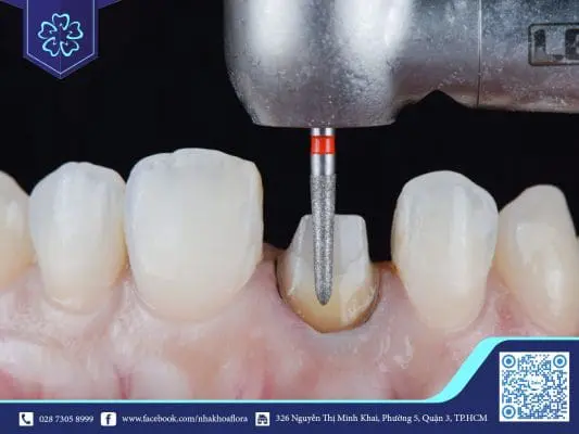 MÀI CÙI RĂNG CÓ ĐAU VÀ ẢNH HƯỞNG GÌ KHÔNG? 1