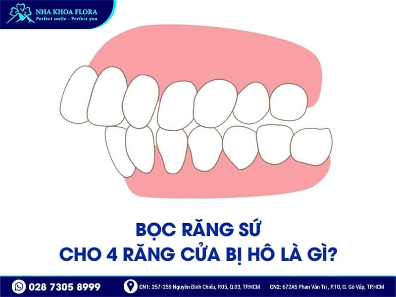 Bọc răng sứ cho 4 răng cửa bị hô - ảnh 1