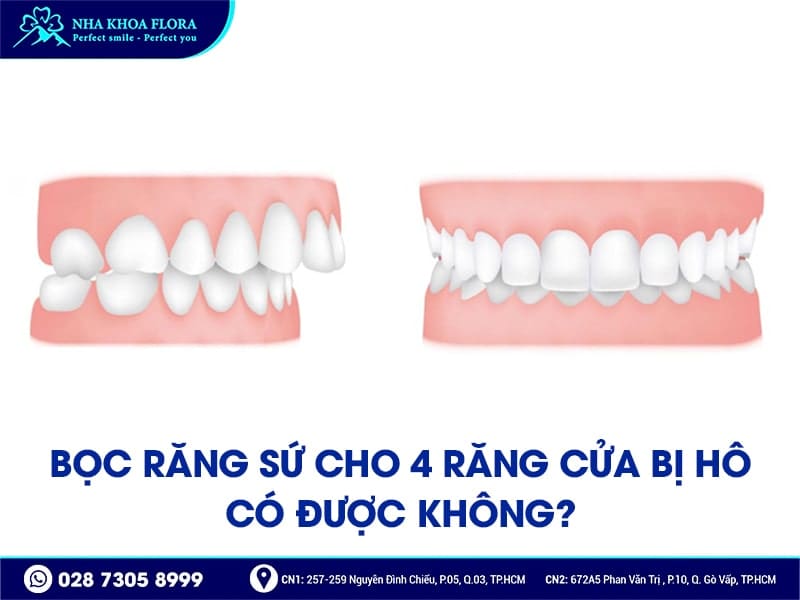 Bọc răng sứ cho 4 răng cửa bị hô - ảnh 2