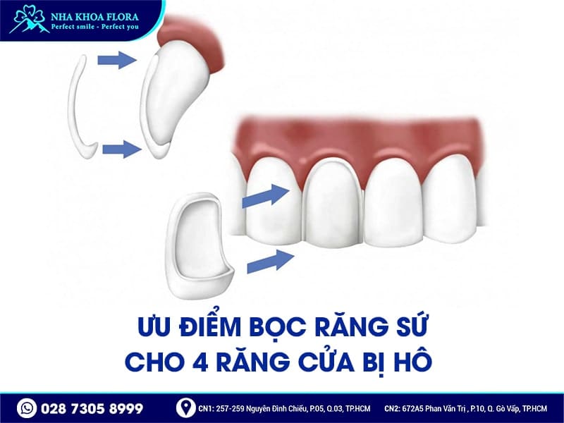 Bọc răng sứ cho 4 răng cửa bị hô - ảnh 3