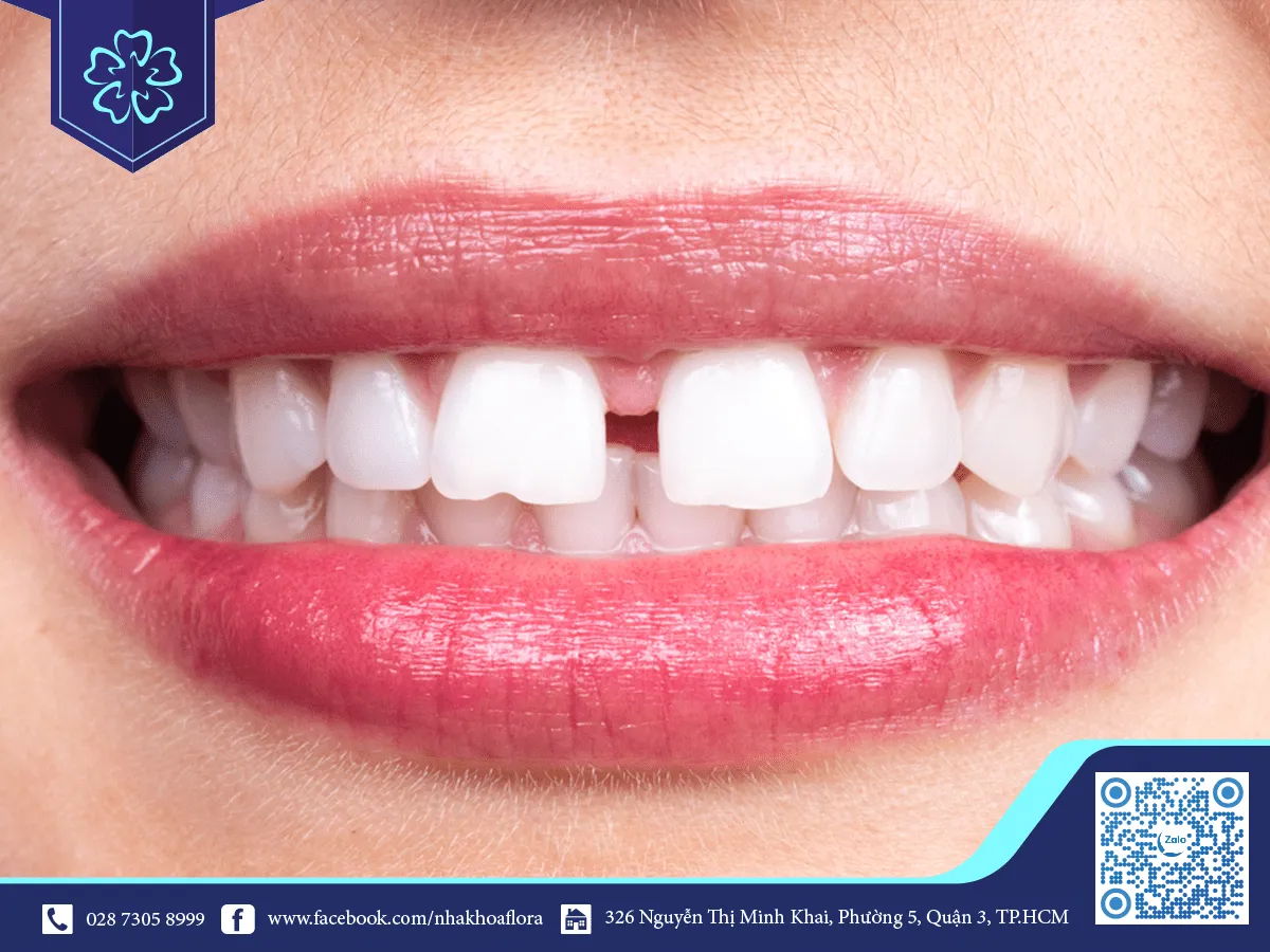 porcelain in frontals