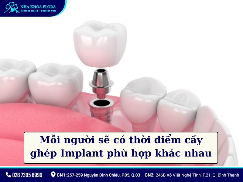sau khi nhổ răng bao lâu thì trồng implant
