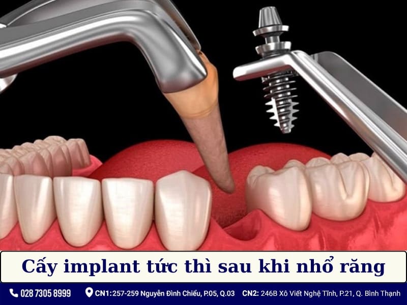 sau khi nhổ răng bao lâu thì trồng implant