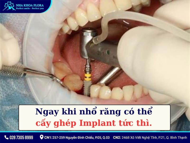 sau khi nhổ răng bao lâu thì trồng implant
