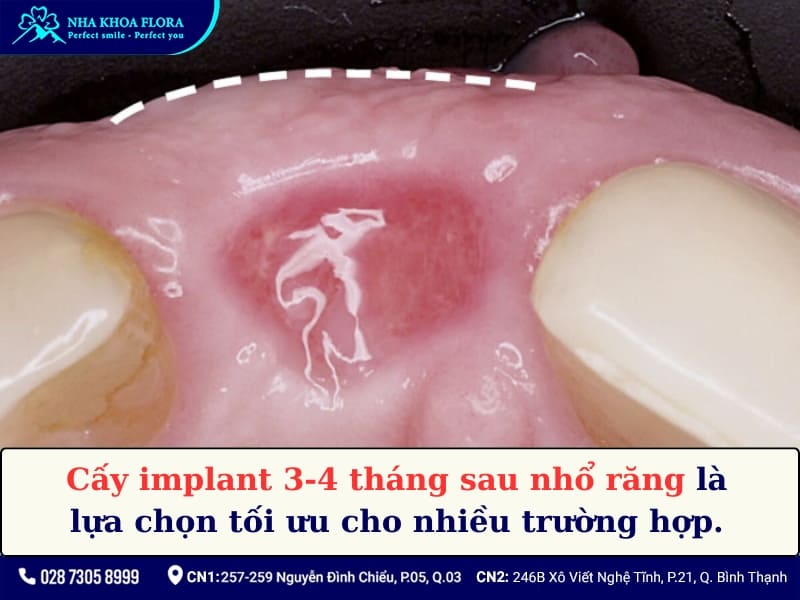 sau khi nhổ răng bao lâu thì trồng implant