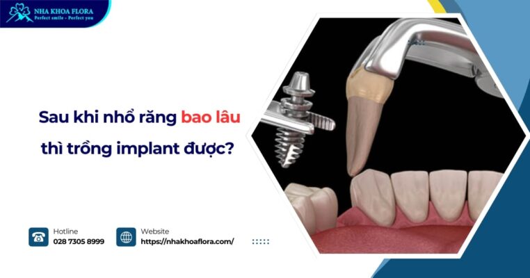 sau khi nhổ răng bao lâu thì trồng implant