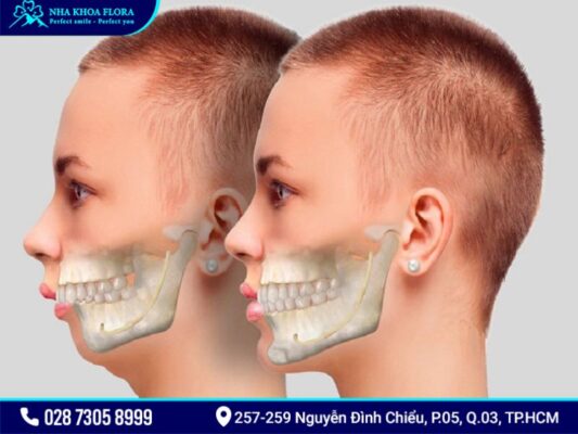 cười hở lợi và hàm hô vẩu - ảnh 1