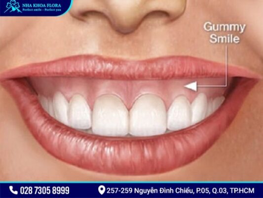 cười hở lợi và hàm hô vẩu - ảnh 2