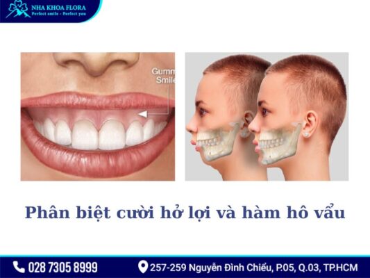 cười hở lợi và hàm hô vẩu - ảnh 3