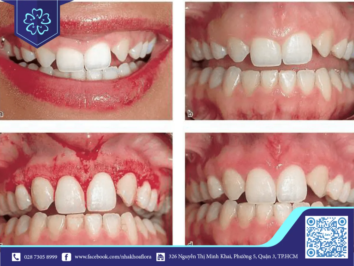 The cases of a gummy smile.