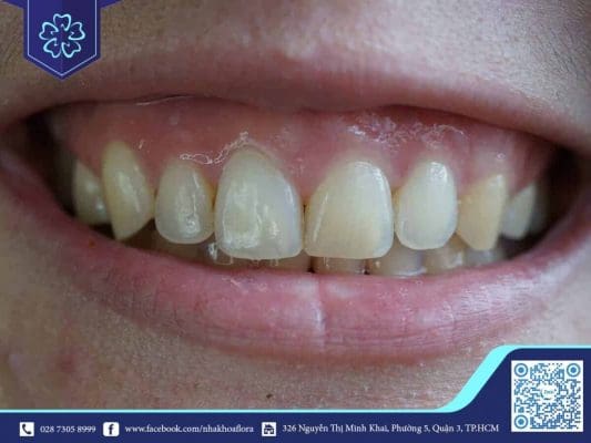 Laughing exposed gums