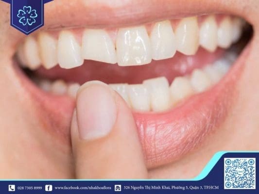 Porcelain teeth are chiseled