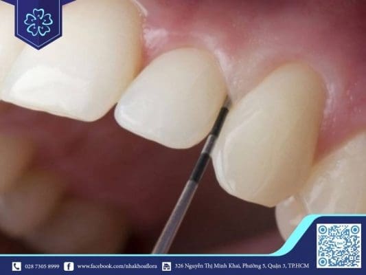 Real teeth are grinded too much.