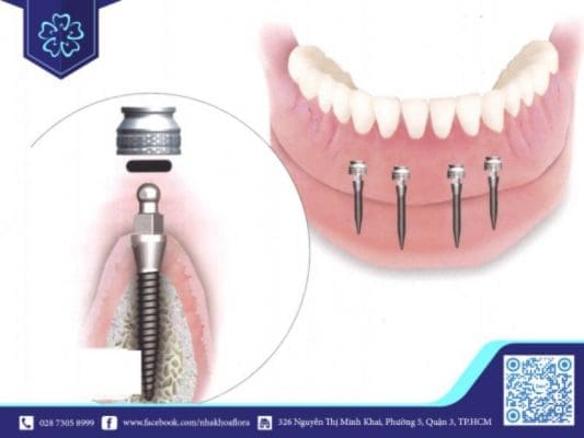 Nên cấy bao nhiêu trụ Implant trên hàm thì tốt nhất?