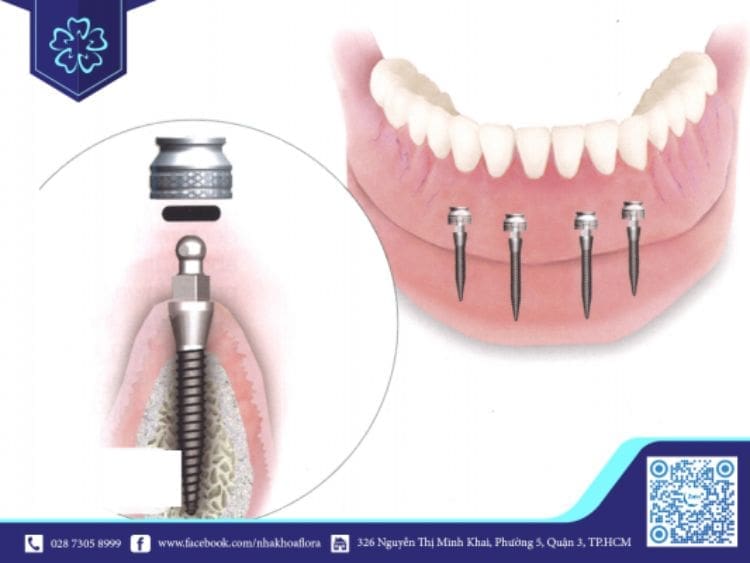 Nên cấy bao nhiêu trụ Implant trên hàm thì tốt nhất?
