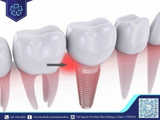Tình trạng viêm xung quanh trụ implant