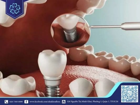 Cấy ghép Implant giá rẻ có hại gì?