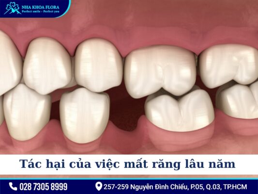Phương pháp điều trị mất răng - ảnh 1