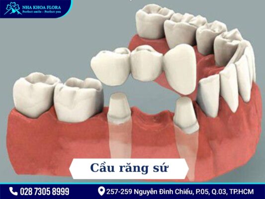 Phương pháp điều trị mất răng - ảnh 3