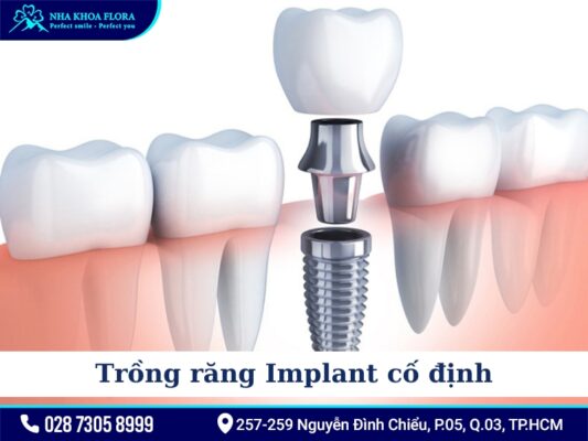 Phương pháp điều trị mất răng - ảnh 4