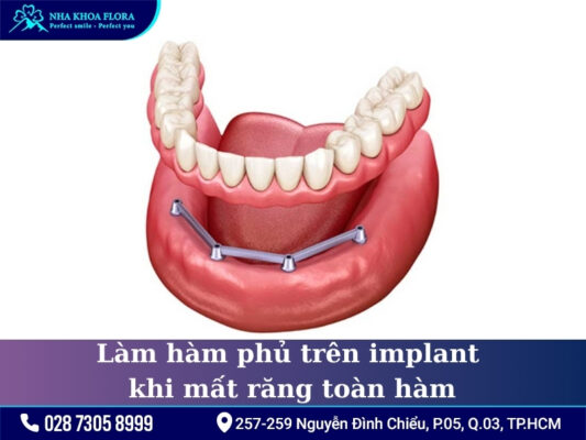 Phương pháp điều trị mất răng - ảnh 6