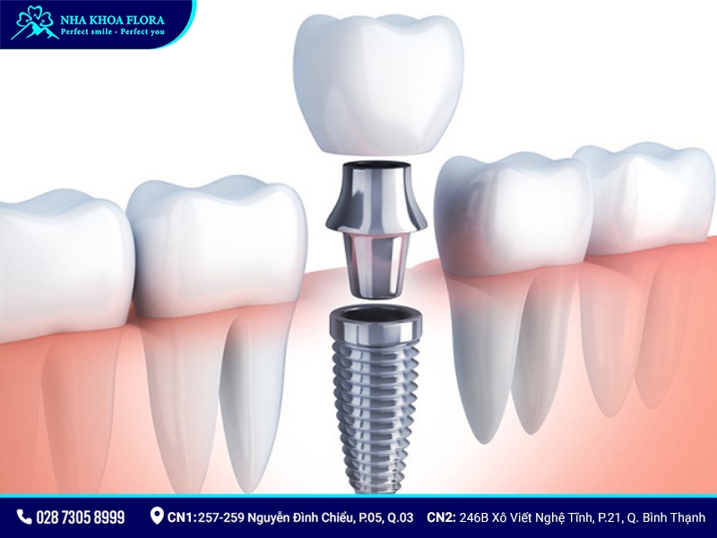 Trồng răng Implant được hàng triệu bệnh nhân mất răng trên toàn cầu lựa chọn hiện nay, bởi khôi phục được cả thân và chân răng bị mất
