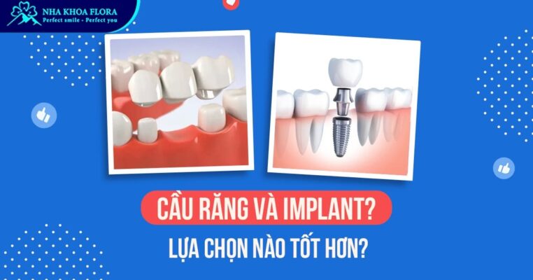 Cầu răng sứ và Implant