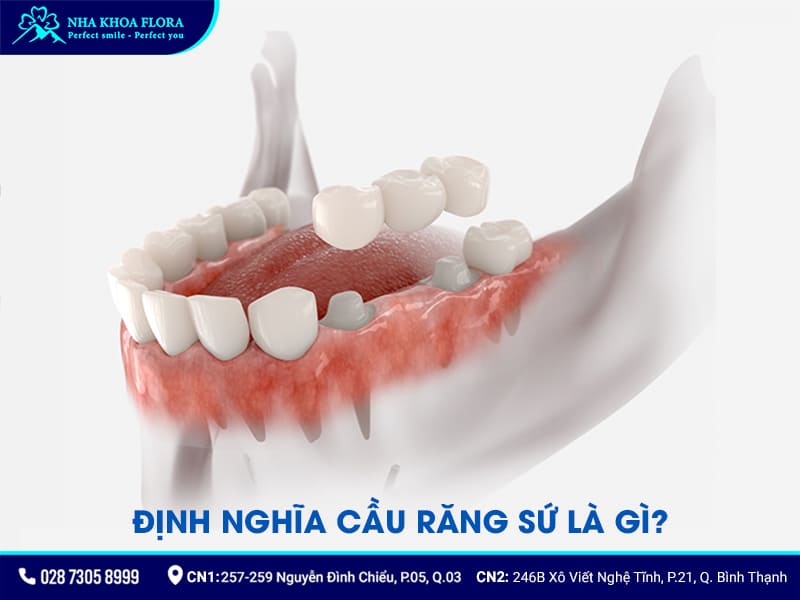Cầu răng sứ là phương pháp phục hình 1 hoặc 2 răng mất liền kề được áp dụng phổ biến hiện nay