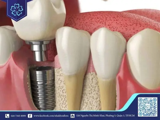 THỰC HƯ VỀ DỊCH VỤ TRỒNG RĂNG IMPLANT GIÁ RẺ TRÊN THỊ TRƯỜNG 1