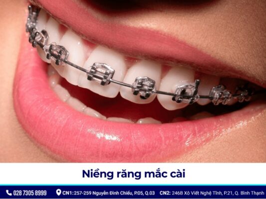 niềng răng mắc cài - ảnh 1
