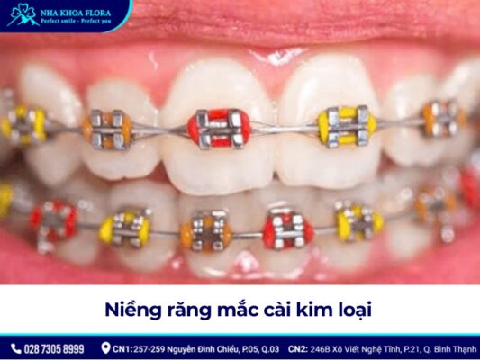 niềng răng mắc cài - ảnh 2
