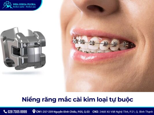 niềng răng mắc cài - ảnh 3