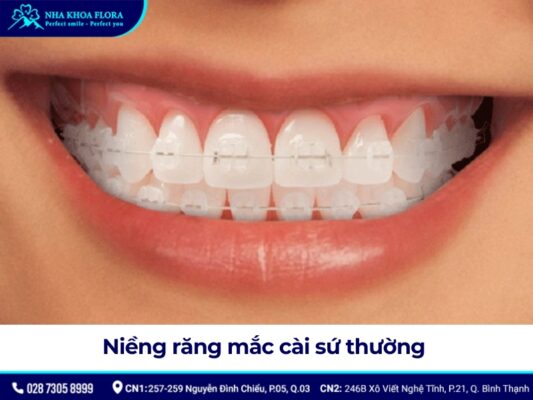 niềng răng mắc cài - ảnh 4