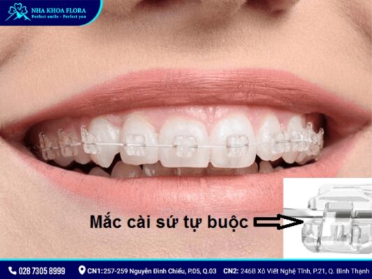 niềng răng mắc cài - ảnh 5