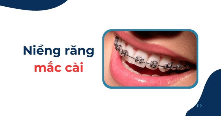 niềng răng mắc cài