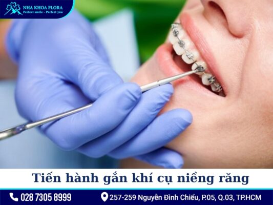 quy trình niềng răng - ảnh 3 quy trình niềng răng - ảnh 3