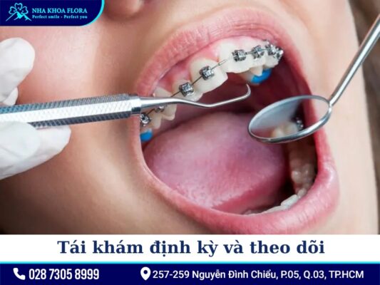 quy trình niềng răng - ảnh 4 quy trình niềng răng - ảnh 4