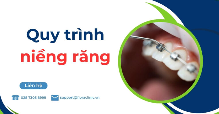 quy trình niềng răng