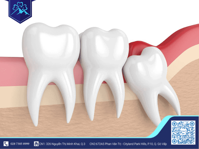 Ứng dụng công nghệ PRF trong nhổ răng khôn - ảnh 2